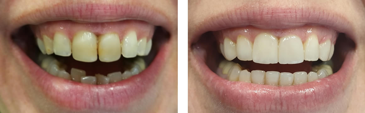 Composite veneers upper and lower jaw