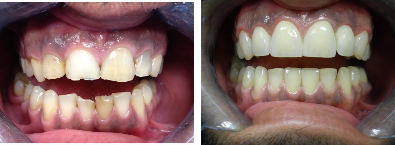 Smile restoration with implant and full ceramic crowns