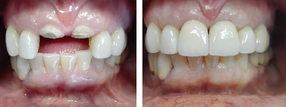 Εμφυτεύματα στα 2 πρόσθια δόντια